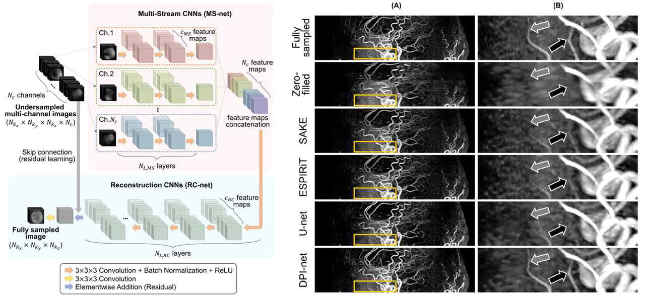 본 연구진이 개발한 멀티 스트림 합성곱 신경망 기반 과소 샘플링된 다 채널 자기 공명 데이터의 재구성 기술 및 결과
