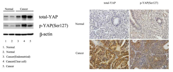 YAP expression and staining in tissues of uterine cancer patients compared to normal endometrium