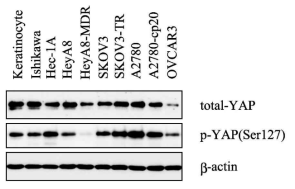 YAP expression in gynecological cancer cells