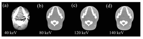 삼중에너지 기반 가상 단일에너지 스펙트럼 전산화단층촬영 기술을 적용하여 획득한 (a)40, (b)80, (c)120, (d)140 keV 영상