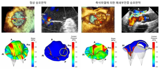 정상 승모판막과 건삭파열에 의한 폐쇄부전증 승모판막의 비교