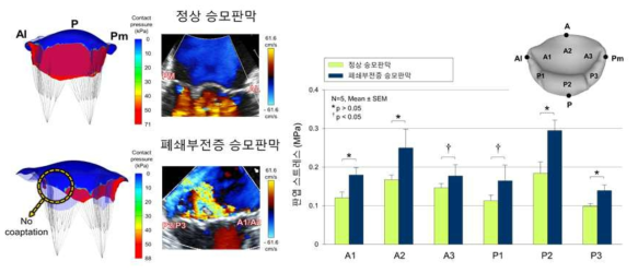 정상 승모판막과 건삭파열에 의한 폐쇄부전증 승모판막의 세부 영역별 판엽응력 비교