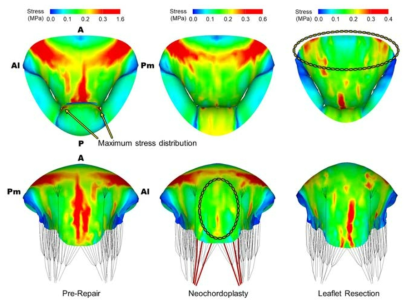 P2 건삭파열 승모판막의 가상 인공건삭/판엽절제 성형술 후 판엽 응력 비교