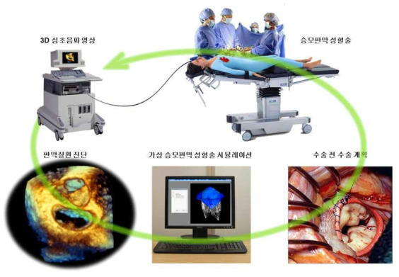 환자맞춤형 가상 승모판막 성형술 시뮬레이션 전략