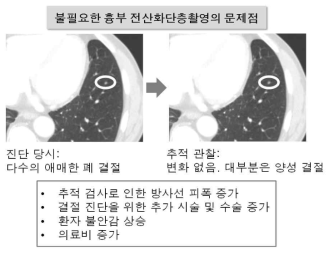 흉부 전산화단층촬영에서 애매한 폐 결절의 예시 및 문제점