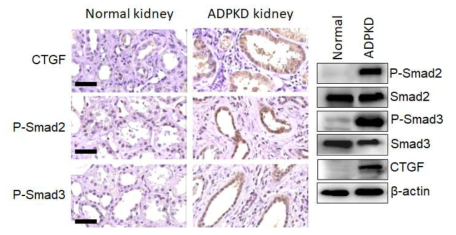 정상인과 다낭신 환자의 신장에서 CTGF의 발현양과 smad2/3가 활성화됨을 조직염색과 WB으로 확인