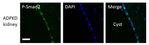 다낭신 환자의 신장 조직에서 P-Smad2의 핵내에서의 위치를 형광염색법으로 확인