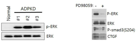 다낭신 환자 낭종 세포의 ERK 인산화 비교와 MEK1 저해제인 PD98059를 처리한 경우 smad3와 CTGF의 변화 확인