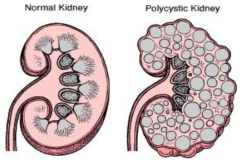 정상 신장(좌측)과 다낭신(우측)의 모식도