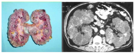 다낭신의 육안적 소견(좌측)과 CT 소견(우측)