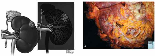 신장암에 대한 모식도