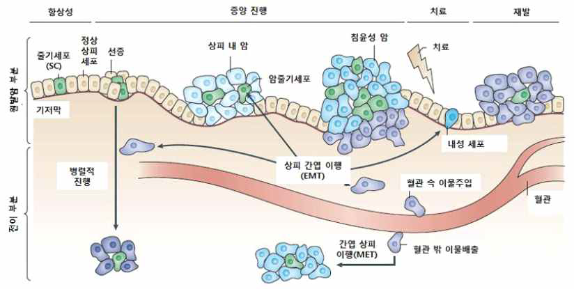 암의 발생 및 진행에서 EMT의 역할