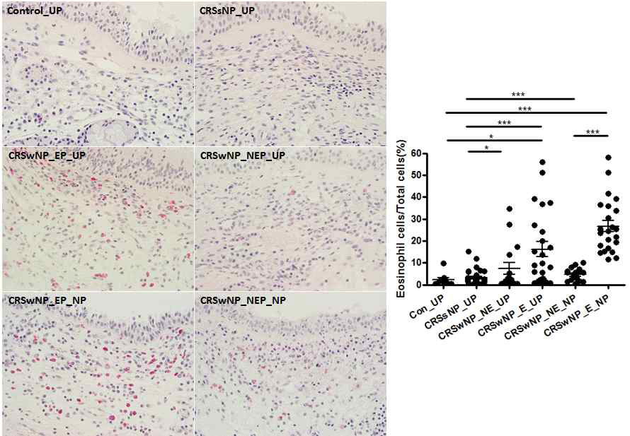 Human uninate process (UP)와 비강 폴립 (NP)에서 호산구의 수에 따른 endotype 분류 - Chronic rhinosinusitis without nasal polyps (CRSsNP), with nasal polyps (CRSwNP), Unciante process (UP), CRSwNP Nasal polyp (NP), Non eosinophilic (NE), Eosinophilic (E)