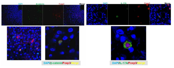 환자 비강 폴립에서 double immunofluorescence (IF)을 수행하여 b-catenin과 Foxp3(좌) 그리고 IL-17A와 Foxp3(우) 발현의 colocalization 확인