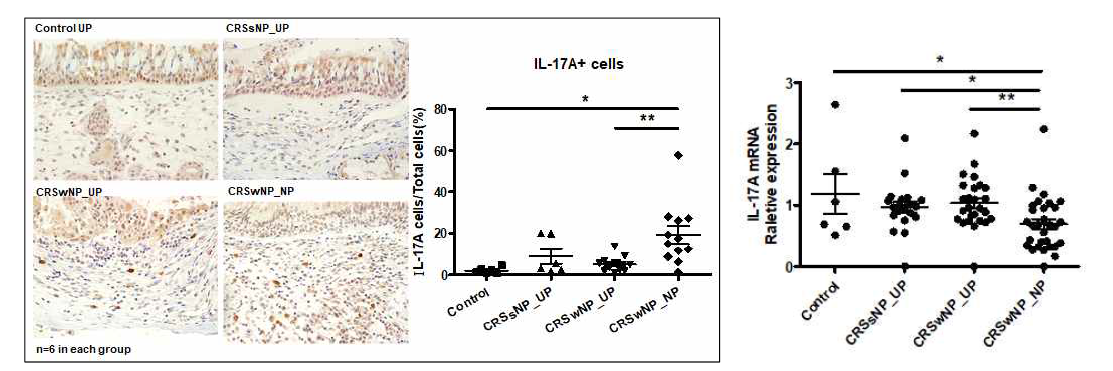 환자 비강 폴립의 IL-17A의 단백질 (IHC, 좌)과 mRNA (RT-PCR, 우) 발현 수준