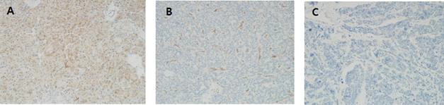 CDC***단백의 발현양상 A. 정상 췌장조직에서는 CDC*** 단백이 발현되는 반면, B. 췌장신경내분비종양과 C. 신경내분비암 조직에서는 CDC*** 단백발현의 소실이 관찰됨