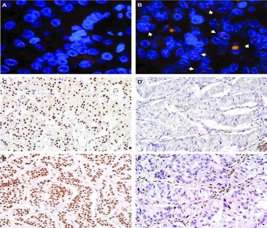 췌장신경내분비 종양에서의 ALT상태와 ATRX와 DAXX의 단백발현. A. ALT-negative B. ALT-positive (화살표, telomere foci) C. ATRX 발현 (40×) D. ATRX 핵내발현소실 (40×) E. DAXX 발현 (40×) F. DAXX 핵내발현소실 (40×). ATRX/DAXX의 핵내소실이 발현한 조직에서는 림프구와 내피세포에서 발현됨(D,F)