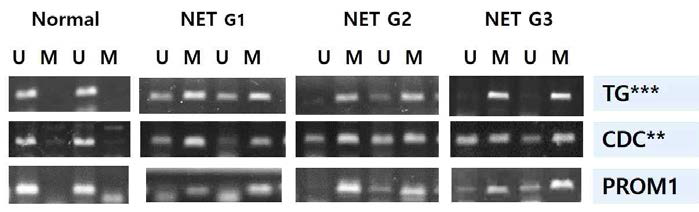 바이오마커 후보 3가지(TG***, CDC***, PR***)의 정상췌장과 췌장 신경내분비종양에서의 메틸화 예시 (U, unmethylation; M, methylation; G,G2,G3 분화도 1,2,3)