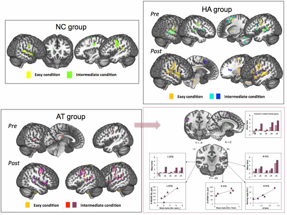 대조군과 난청군에서의 fMRI그룹분으로 4개의 난이도 중 easy, intermediate조건 하 결과. (우측하단) 청능훈련군에서 전/ 후 비교결과로, intermediate 조건에서 유일하게 유의한 차이가 관찰되었으며 보라색으로 표시된 영역이 3개월 후 유의하게 활성도가 증가된 영역이다. 이와 관련된 임상지표들과의 상관분석을 그래프로 나타내었다