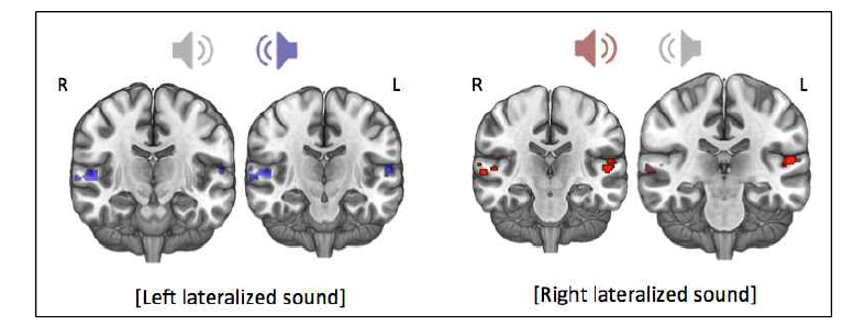 정상대조군에서 양이청 녹음을 통한 방향분별능과제에 대한 fMRI 결과를 도출. (FWE-corrected p < 0.05)