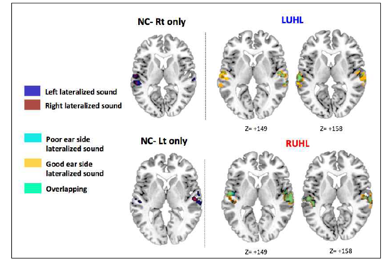좌측의 그림은 건청인에서 일측귀의 차폐를 통한 fMRI결과이다 (FWE-corrected p< 0.05). 우측의 그림은 위쪽은 좌측난청군의 결과이며 (FWE-corrected p < 0.05), 아래 그림은 우측난청군의 결과이다 (FDR-corrected p<0.01)
