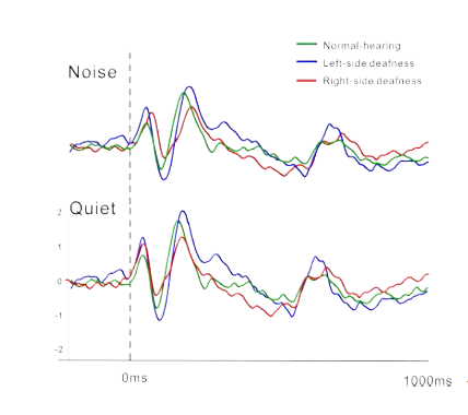 Effect of Noise(왼쪽그림). 왼쪽 난청, 오른쪽 난청, 정상청력인의 소음이 있는 환경과 없는 환경에서의 waveform 비교