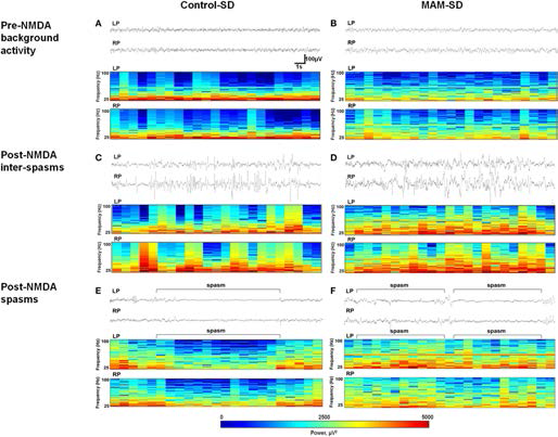 Electroencephalographic (EEG) recordings and color density spectral arrays (CDSAs) of N-methyl-d-aspartate (NMDA)-induced spasms and inter-spasm periods