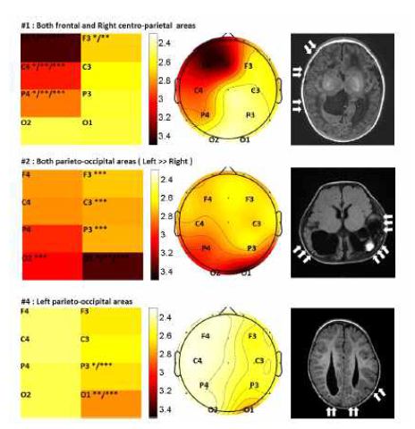 Color map and topogrophy of the FO-ERSP distribution (left and middle) and T2 or T2 FLAIR MR imaging findings (right) in the focal/multifocal pathology group