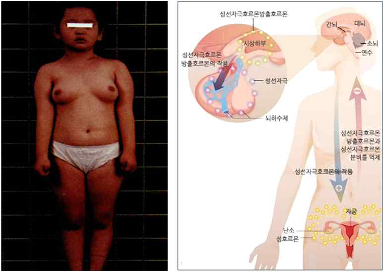 성조숙증 환아의 임상사진(좌: 초등학교 1학년 때 생리 시작)과 성조숙증 관련의 호르몬 작용 경로(우)