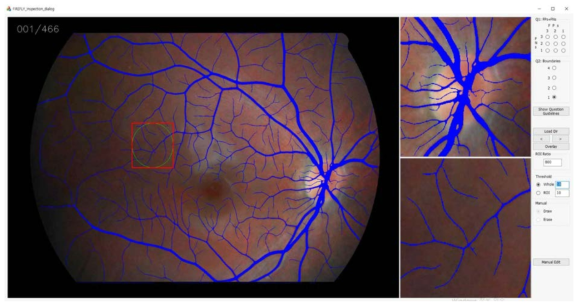 개발된 혈관 추출 GUI. 좌측의 큰 패널은 입력 영상 및 덧그린 혈관 추출 결과를 전체적으로 모두 보이며 우측의 작은 상하 패널은 현재 마우스 커서 위치 및 시신경 유두의 줌 화면을 보임. 제일 오른쪽에는 혈관 편집 모드 변경, 파일 탐색, 줌 비율 조정 등의 기능을 갖는 버튼들이 배치되어 있음