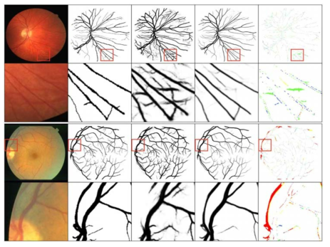 개발된 완전자동 혈관추출용 신규 CNN 구조인 SSANet의 결과 예시. 좌측 첫째 열: 입력영상, 둘째 열: 혈관 영역 참값, 셋째 열: 타 기법 (DRIU, Maninis et al., 2016) 결과, 넷째 열: SSANet 기법 결과, 다섯째 열: DRIU/SSANet 기법 결과 차 영상 – 빨간색/초록색은 제안 기법에서 참값에 맞도록 추출/억제된 혈관에 해당하는 픽셀을 나타냄