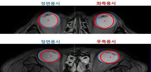 좌·우측 응시할 때 안구의 움직임 관찰