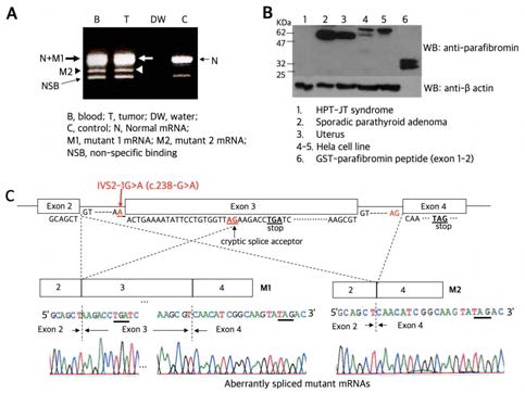 HPT-JT 증후군 환자의 혈액과 부갑상선암에서 시행한 RT-PCR(A) 결과, 화살표[정상과 변이(M1) mRNA의 혼합], 화살촉[변이(M2) mRNA]가 확인됨. 웨스턴 블롯 분석결과(B), lane 1의 HPT-JT에서 parafibromin 단백질이 발현되지 않음. TOPO-클로닝 결과(C), 인트론2의 IVS2-1G>A 변이에 의해 두 종의 변이 mRNA, 즉, M1(exon 3의 앞 23bp가 deleted된 mRNA) 및 M2[exon 3 전부(70bp)가 deleted된 mRNA]가 존재하는 것을 확인함. 또한, TagMan Probe를 이용하여 실시간 정량 RT-PCR 결과 조직 내에서 두 변이 mRNA가 상당량 발현되는 것을 확인함