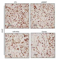 tumor 조직에서 Ki-67의 immunohistochemistry 결과