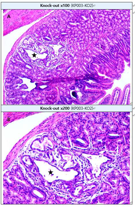 Cystic dilation in Brunner’s gland in duodenum (H&E staining) A: duodenum, B : High-magnification of A