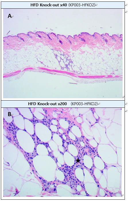 Inflammatory macrophage infiltration in subcutaneous adipose layer (H&E staining) A: Skin layer B : High-magnification of A