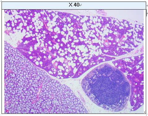 Lipomatosis on salivary gland (H&E staining)