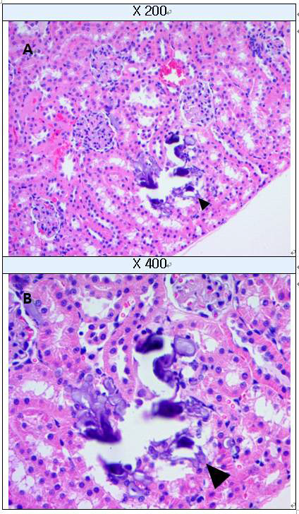 Calcification in kidney (H&E staining) A : Kidney, B : High-magnification of A