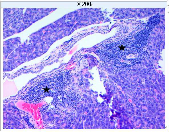 Pancreatitis; Lymphocytic infiltration (H&E staining)