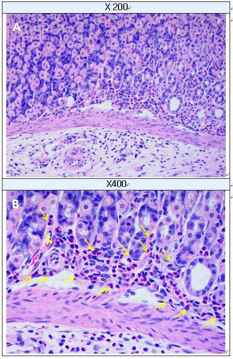 Eosinophills infiltration in fundus of stomach (H&E staining) A: Stomach, B : High-magnification of A