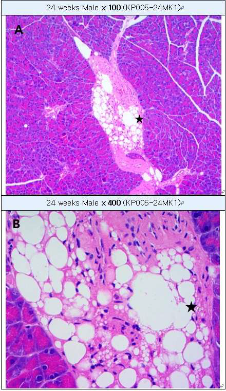 Vacuolation in artery of pancreas A: Vacuolation in artery of pancreas, B : High-magnification of A