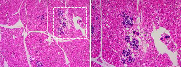 Calcification 된 Brown adipose tissue