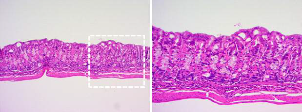 SPEM, Submucosal inflammation eosinophil