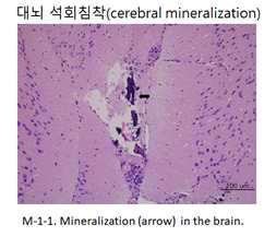 대뇌 석회 침착