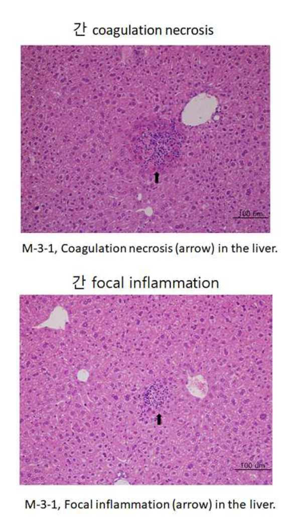 Coagulation necrosis