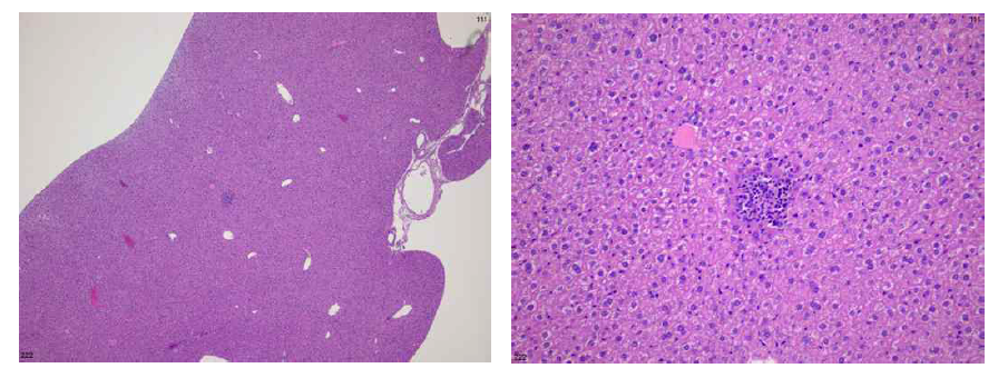 WT 마우스의 간: multifocal infiltrates, neutrophils