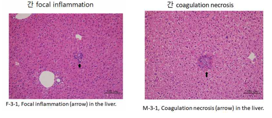 liver의 Focal inflammation 및 Coagulation necrosis