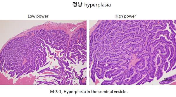 정낭의 Hyperplasia