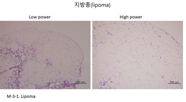 Lipoma