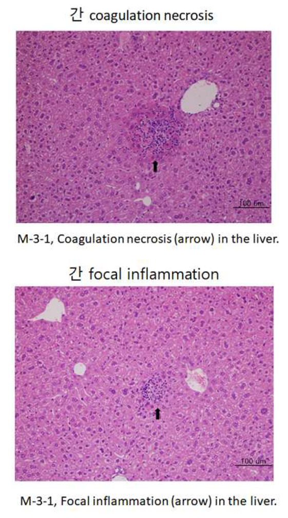 Coagulation necrosis